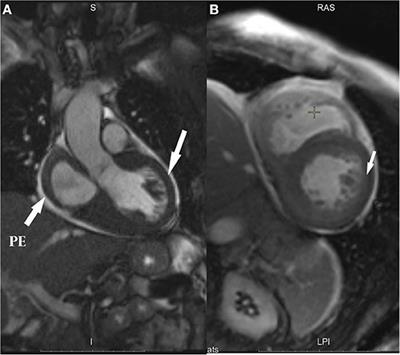 Case Report: AL Amyloidosis Severe Restrictive Cardiomyopathy Associated With Multiple Myeloma—Diagnostic Difficulties